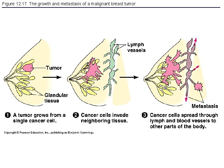 Figure 12. 17 The growth and metastasis of a malignant breast tumor 