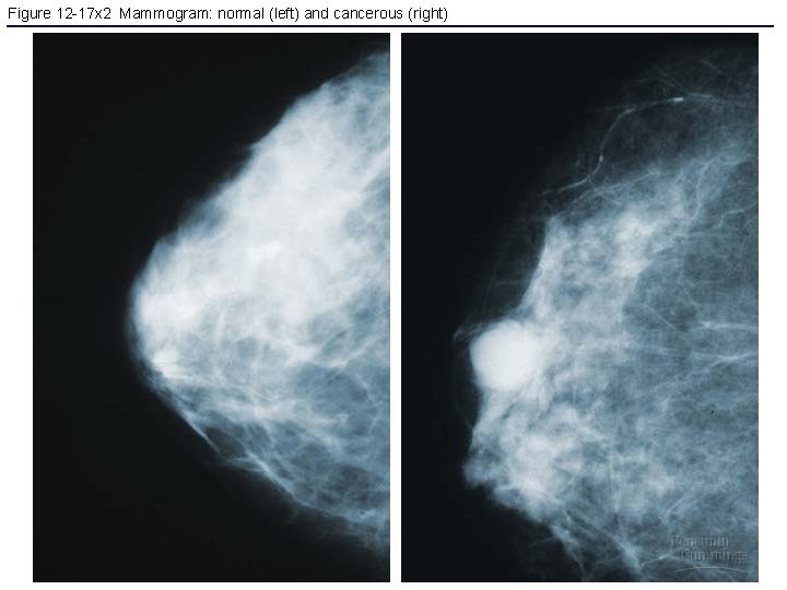 Figure 12 -17 x 2 Mammogram: normal (left) and cancerous (right) 