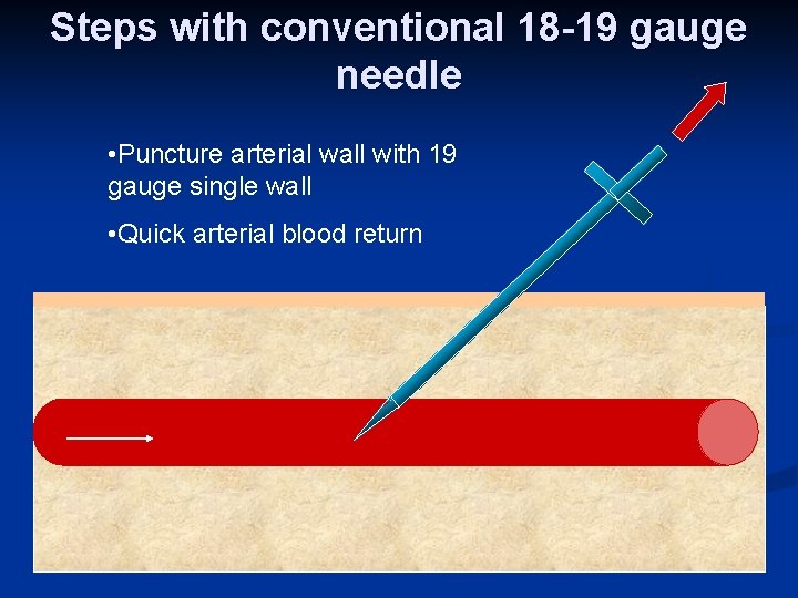 Steps with conventional 18 -19 gauge needle • Puncture arterial wall with 19 gauge