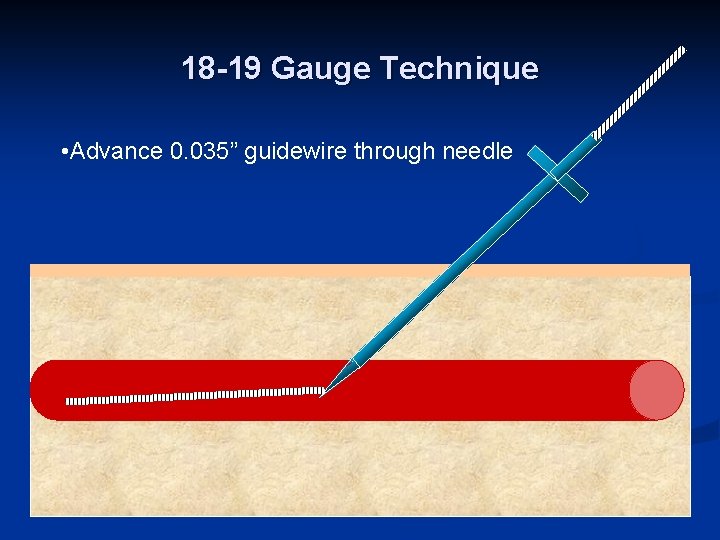 18 -19 Gauge Technique • Advance 0. 035” guidewire through needle 