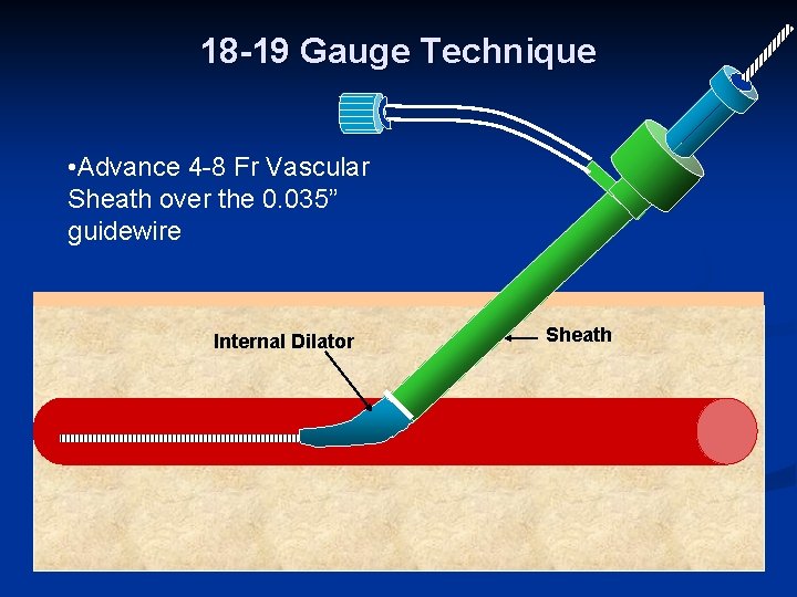 18 -19 Gauge Technique • Advance 4 -8 Fr Vascular Sheath over the 0.