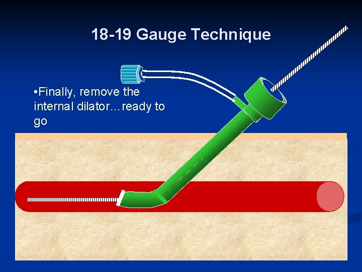 18 -19 Gauge Technique • Finally, remove the internal dilator…ready to go 