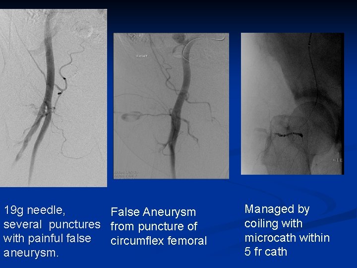 19 g needle, False Aneurysm several punctures from puncture of with painful false circumflex