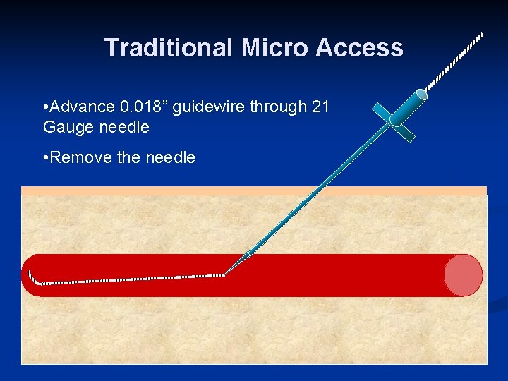 Traditional Micro Access • Advance 0. 018” guidewire through 21 Gauge needle • Remove