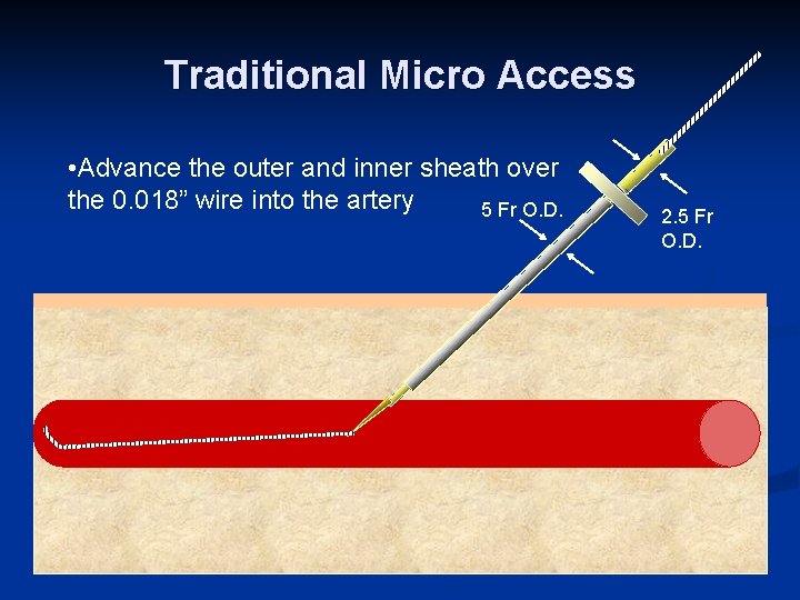 Traditional Micro Access • Advance the outer and inner sheath over the 0. 018”