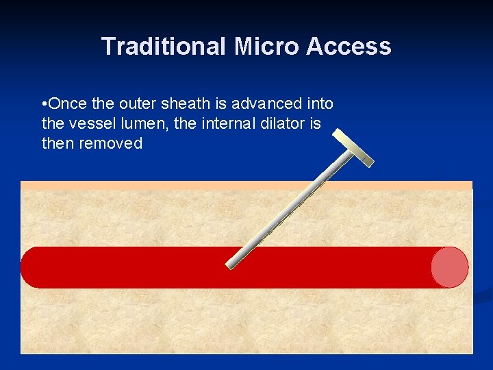 Traditional Micro Access • Once the outer sheath is advanced into the vessel lumen,