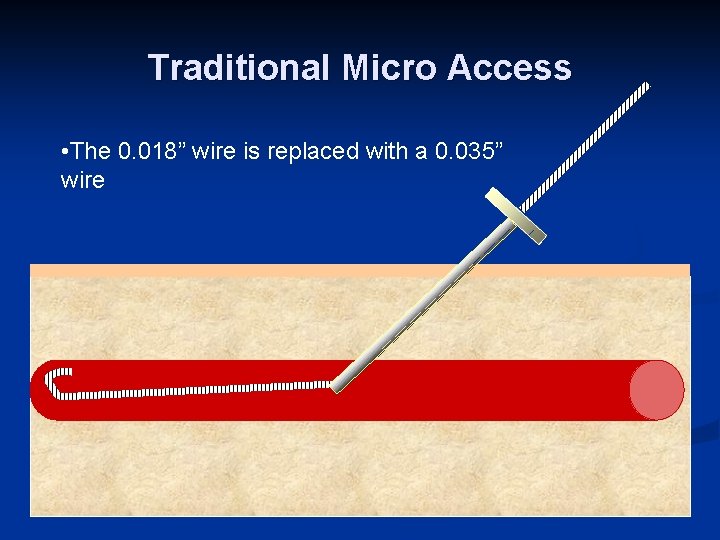 Traditional Micro Access • The 0. 018” wire is replaced with a 0. 035”