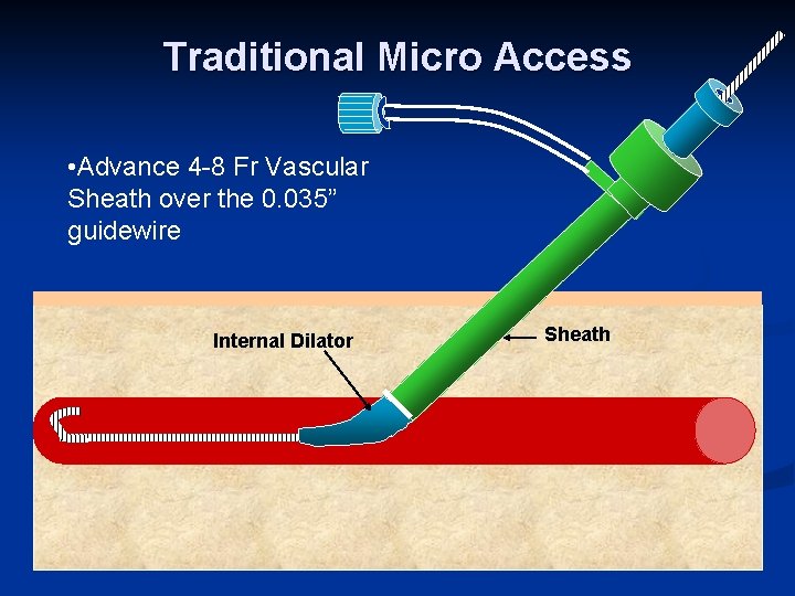 Traditional Micro Access • Advance 4 -8 Fr Vascular Sheath over the 0. 035”