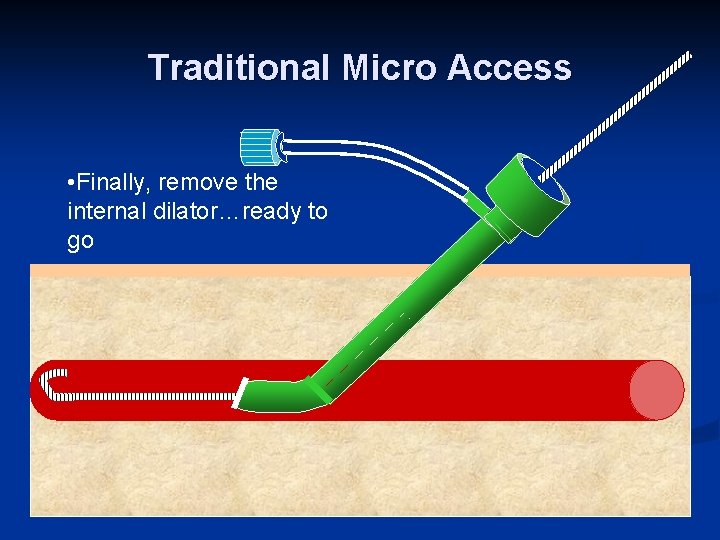 Traditional Micro Access • Finally, remove the internal dilator…ready to go 