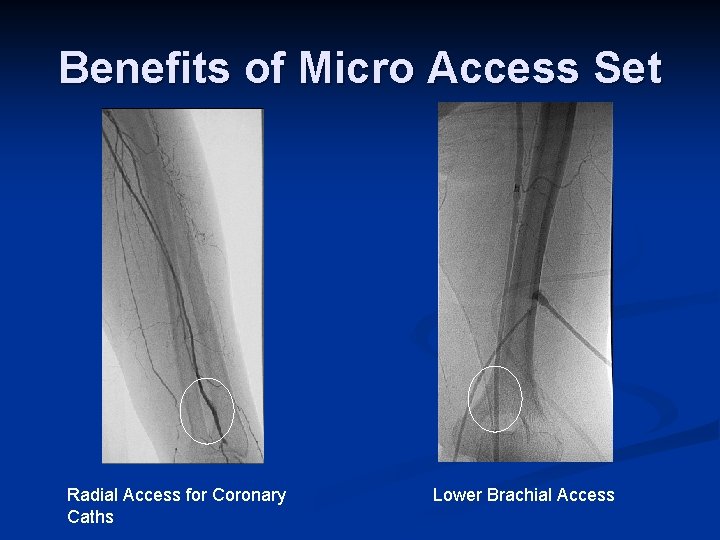 Benefits of Micro Access Set Radial Access for Coronary Caths Lower Brachial Access 