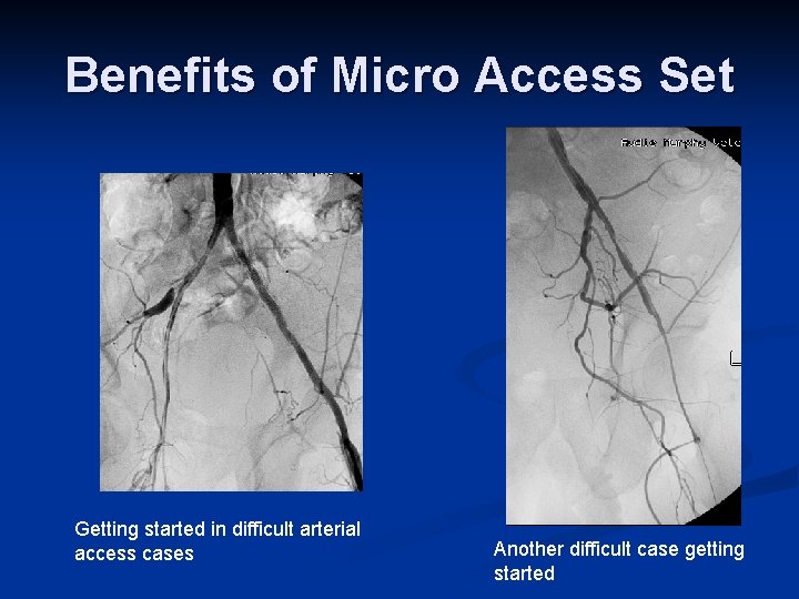 Benefits of Micro Access Set Getting started in difficult arterial access cases Another difficult