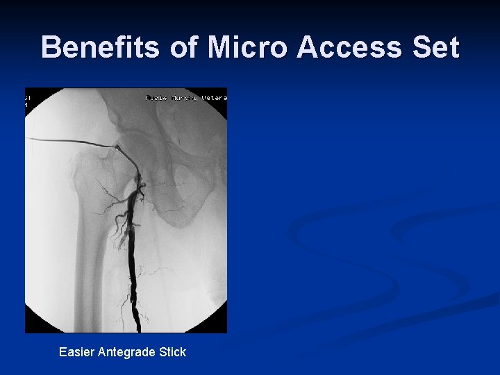 Benefits of Micro Access Set Easier Antegrade Stick 