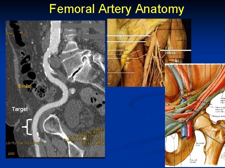 Femoral Artery Anatomy CFA CFV Fem Nerve Target 