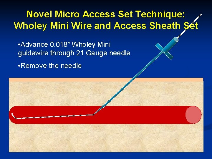 Novel Micro Access Set Technique: Wholey Mini Wire and Access Sheath Set • Advance