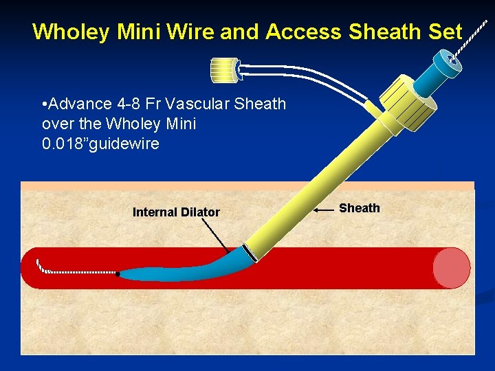 Wholey Mini Wire and Access Sheath Set • Advance 4 -8 Fr Vascular Sheath