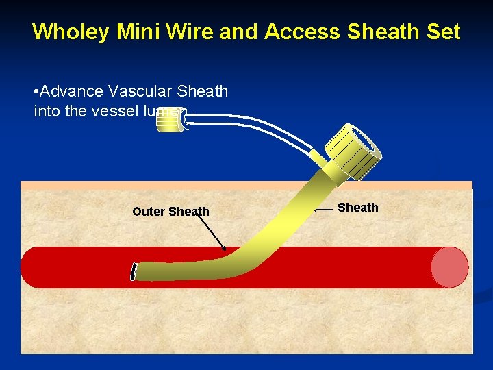 Wholey Mini Wire and Access Sheath Set • Advance Vascular Sheath into the vessel