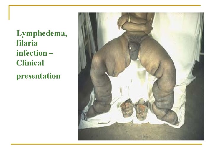 Lymphedema, filaria infection – Clinical presentation 