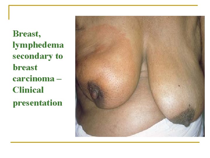 Breast, lymphedema secondary to breast carcinoma – Clinical presentation 