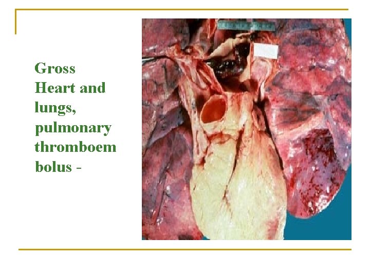 Gross Heart and lungs, pulmonary thromboem bolus - 