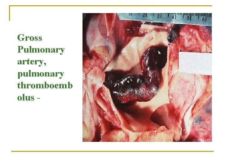 Gross Pulmonary artery, pulmonary thromboemb olus - 