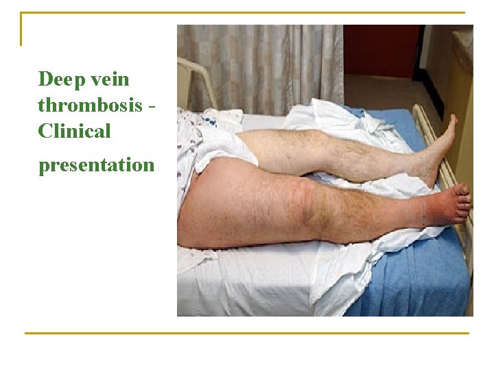Deep vein thrombosis Clinical presentation 