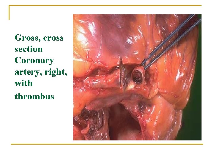 Gross, cross section Coronary artery, right, with thrombus 