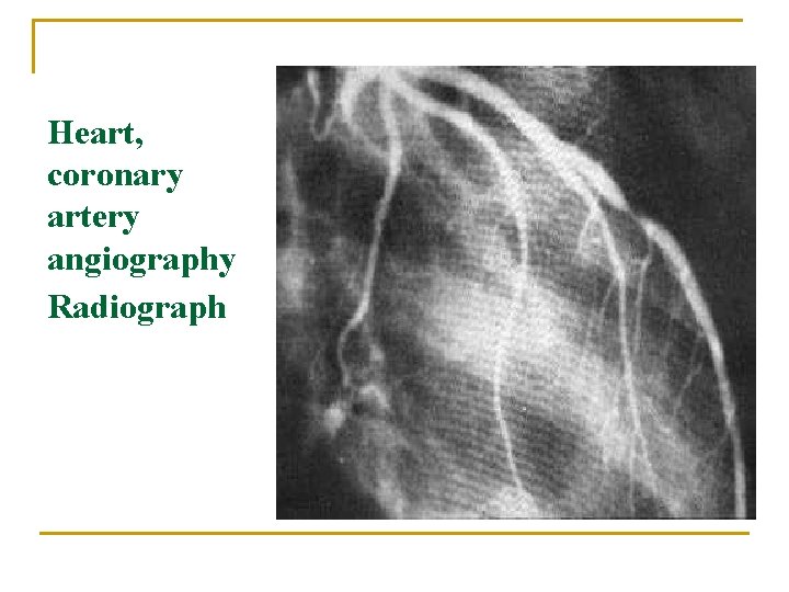 Heart, coronary artery angiography Radiograph 