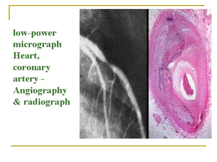 low-power micrograph Heart, coronary artery Angiography & radiograph 