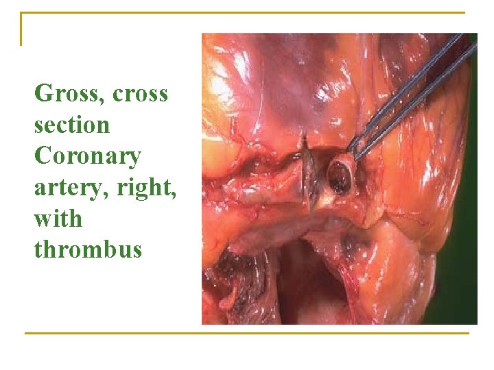 Gross, cross section Coronary artery, right, with thrombus 