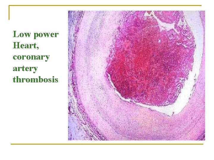 Low power Heart, coronary artery thrombosis 