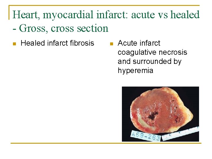 Heart, myocardial infarct: acute vs healed - Gross, cross section n Healed infarct fibrosis