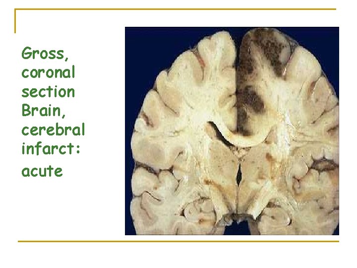 Gross, coronal section Brain, cerebral infarct: acute 