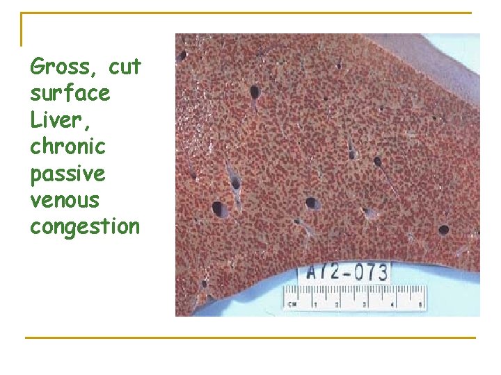 Gross, cut surface Liver, chronic passive venous congestion 