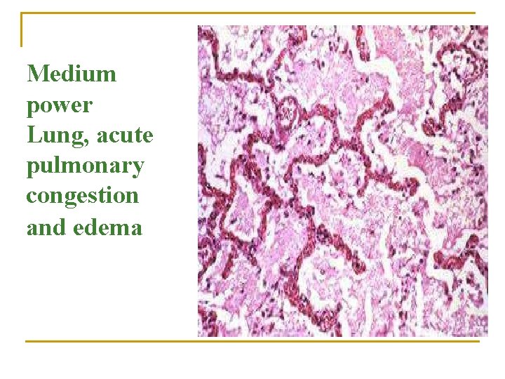 Medium power Lung, acute pulmonary congestion and edema 