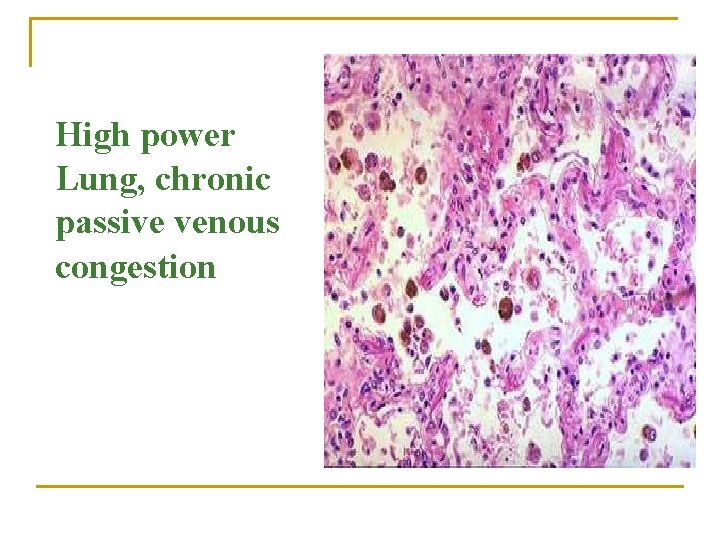 High power Lung, chronic passive venous congestion 