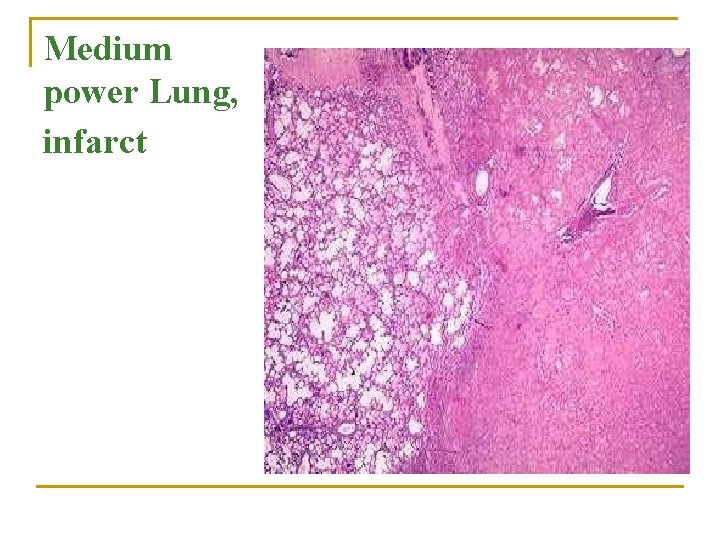 Medium power Lung, infarct 