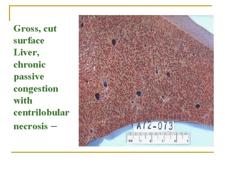 Gross, cut surface Liver, chronic passive congestion with centrilobular necrosis – 