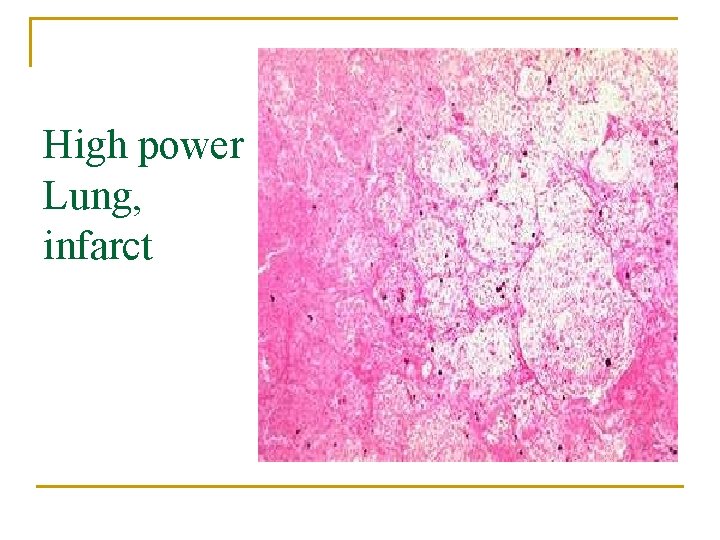 High power Lung, infarct 