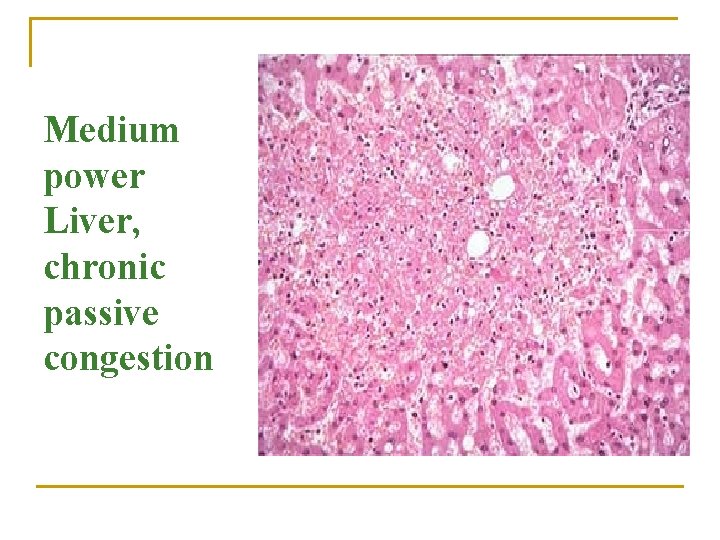 Medium power Liver, chronic passive congestion 