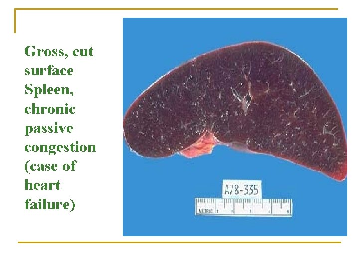 Gross, cut surface Spleen, chronic passive congestion (case of heart failure) 