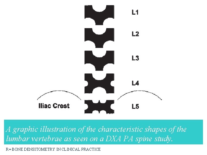 A graphic illustration of the characteristic shapes of the lumbar vertebrae as seen on