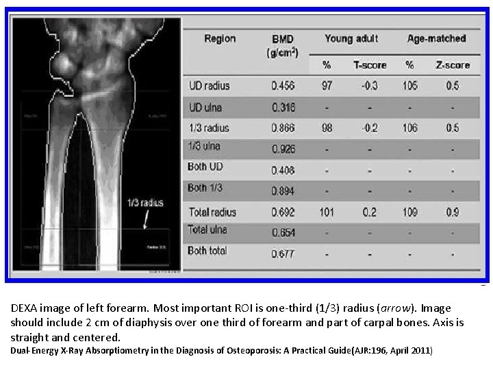 DEXA image of left forearm. Most important ROI is one-third (1/3) radius (arrow). Image