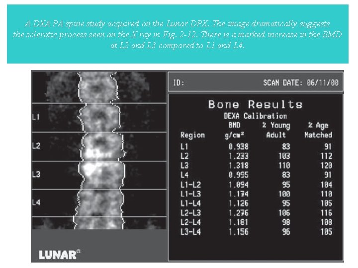 A DXA PA spine study acquired on the Lunar DPX. The image dramatically suggests