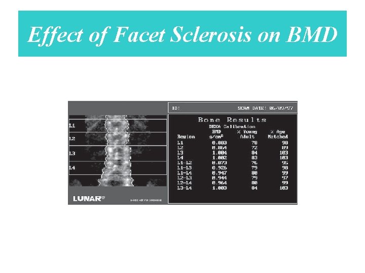 Effect of Facet Sclerosis on BMD 