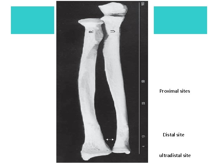 Proximal sites Distal site ultradistal site 