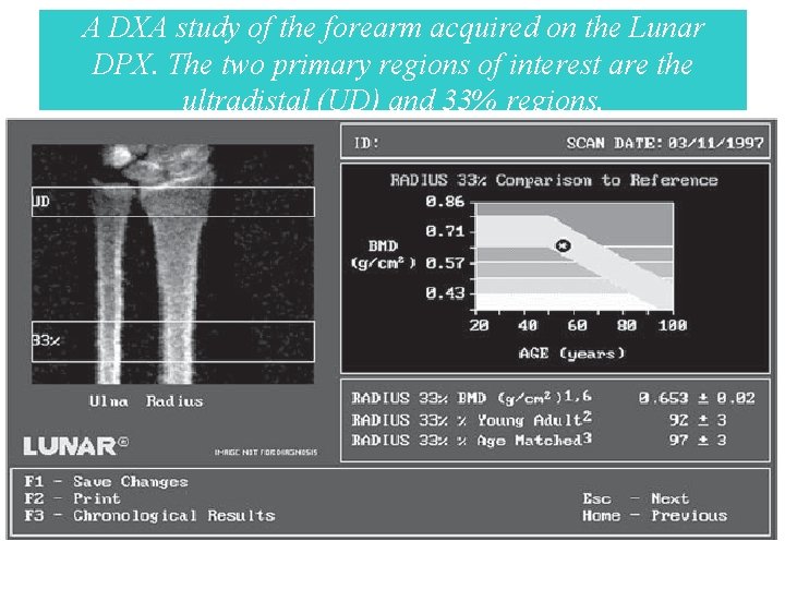 A DXA study of the forearm acquired on the Lunar DPX. The two primary