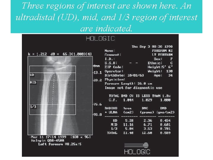 Three regions of interest are shown here. An ultradistal (UD), mid, and 1/3 region