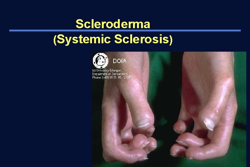 Scleroderma (Systemic Sclerosis) 