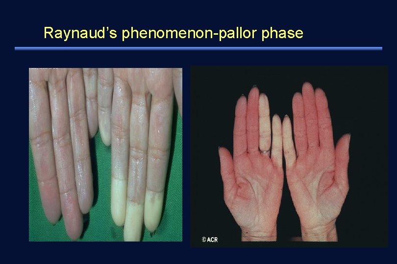 Raynaud’s phenomenon-pallor phase 