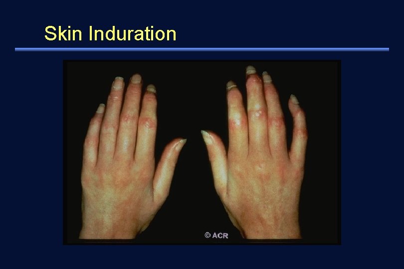 Skin Induration 